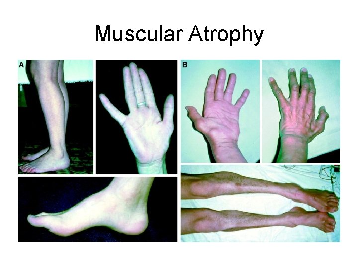 Muscular Atrophy 