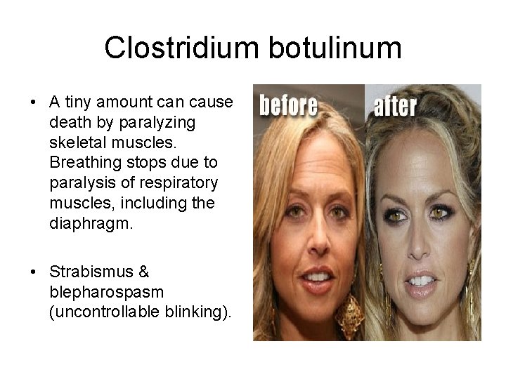 Clostridium botulinum • A tiny amount can cause death by paralyzing skeletal muscles. Breathing