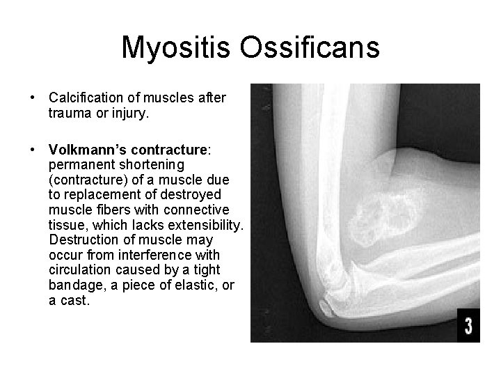 Myositis Ossificans • Calcification of muscles after trauma or injury. • Volkmann’s contracture: permanent