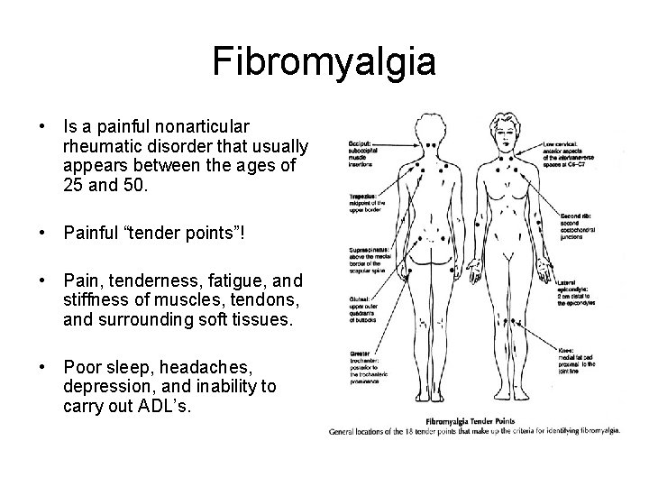 Fibromyalgia • Is a painful nonarticular rheumatic disorder that usually appears between the ages