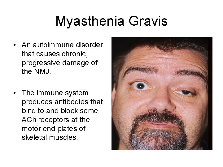 Myasthenia Gravis • An autoimmune disorder that causes chronic, progressive damage of the NMJ.