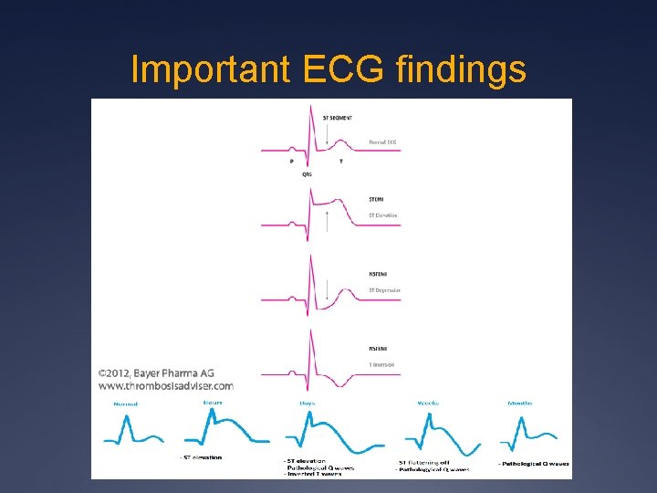 Important ECG findings 