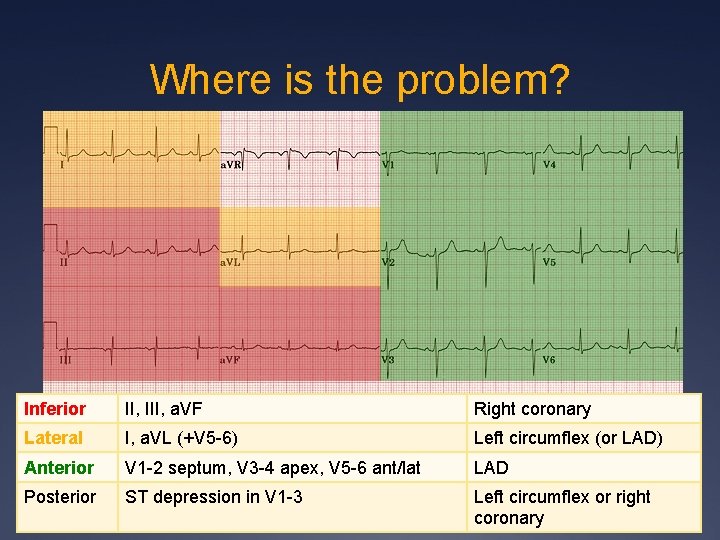 Where is the problem? Inferior II, III, a. VF Right coronary Lateral I, a.