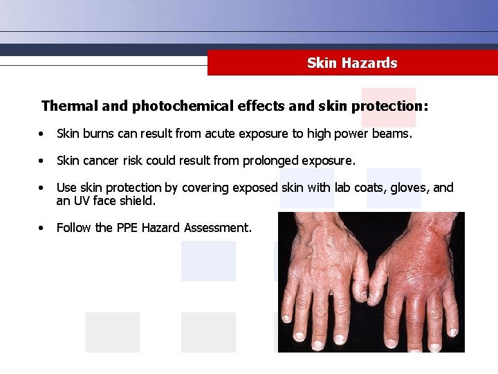 Skin Hazards Thermal and photochemical effects and skin protection: • Skin burns can result