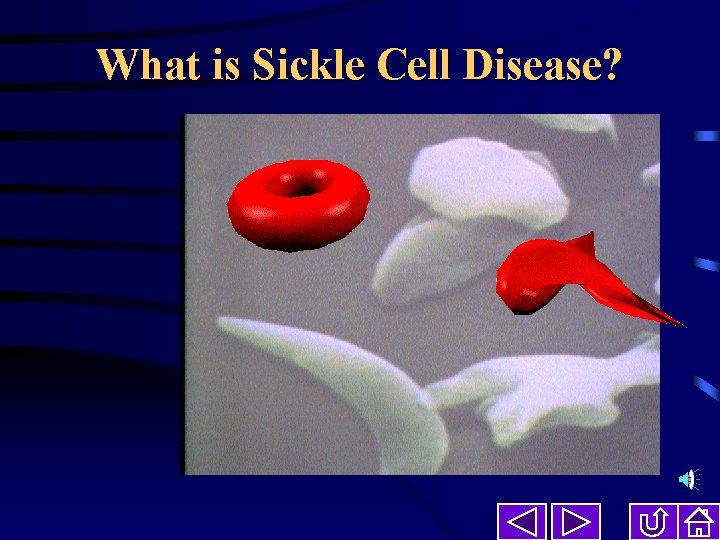 What is Sickle Cell Disease? 