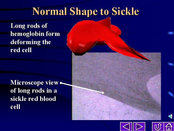 Normal Shape to Sickle Long rods of hemoglobin form deforming the red cell Microscope