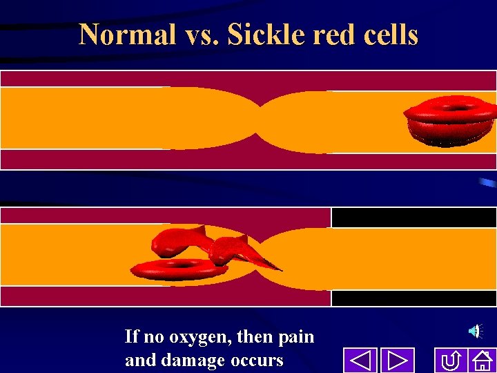 Normal vs. Sickle red cells If no oxygen, then pain and damage occurs 