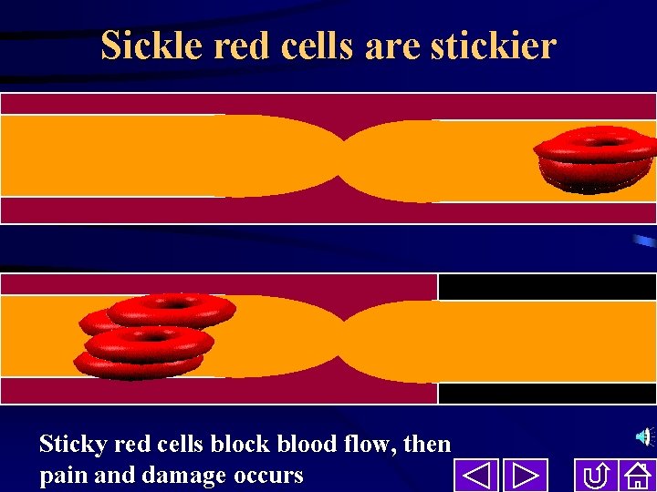 Sickle red cells are stickier Sticky red cells block blood flow, then pain and