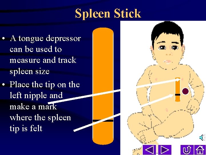 Spleen Stick • A tongue depressor can be used to measure and track spleen