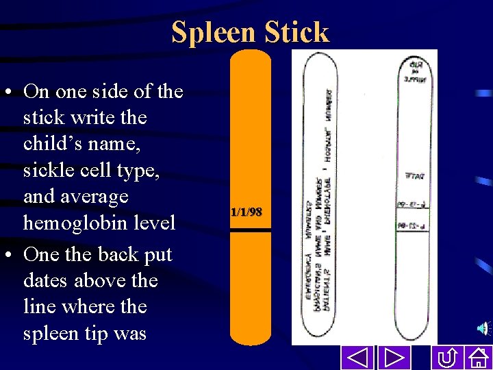 Spleen Stick • On one side of the stick write the child’s name, sickle