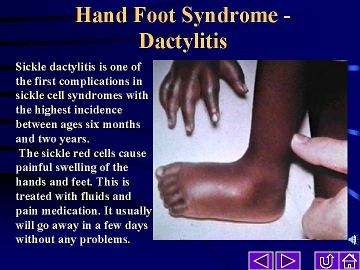 Hand Foot Syndrome Dactylitis Sickle dactylitis is one of the first complications in sickle