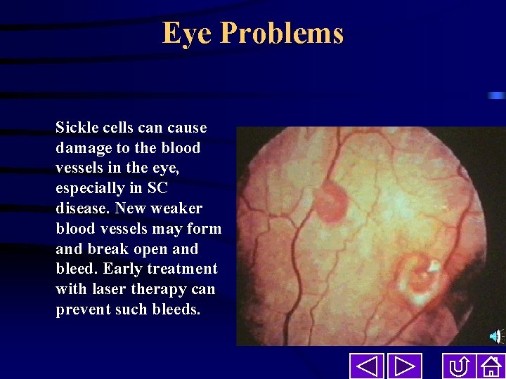 Eye Problems Sickle cells can cause damage to the blood vessels in the eye,