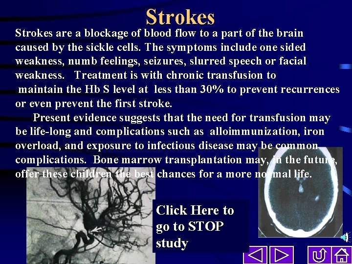 Strokes are a blockage of blood flow to a part of the brain caused