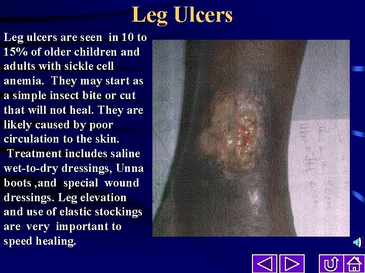 Leg Ulcers Leg ulcers are seen in 10 to 15% of older children and