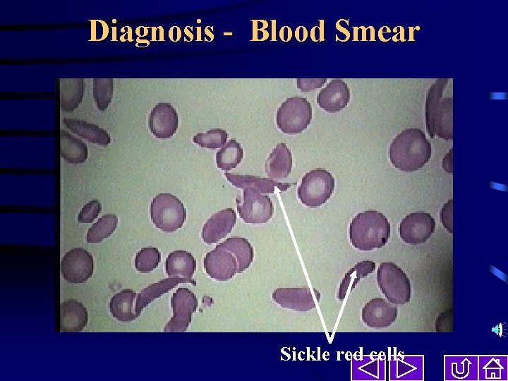 Diagnosis - Blood Smear Sickle red cells 