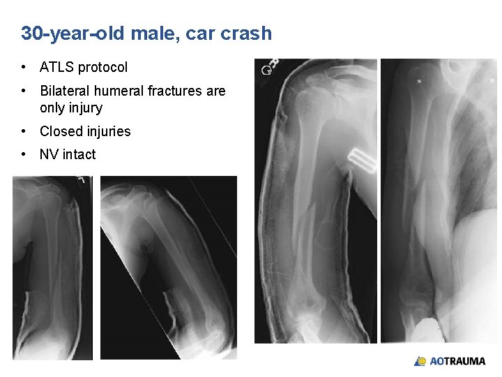 30 -year-old male, car crash • ATLS protocol • Bilateral humeral fractures are only