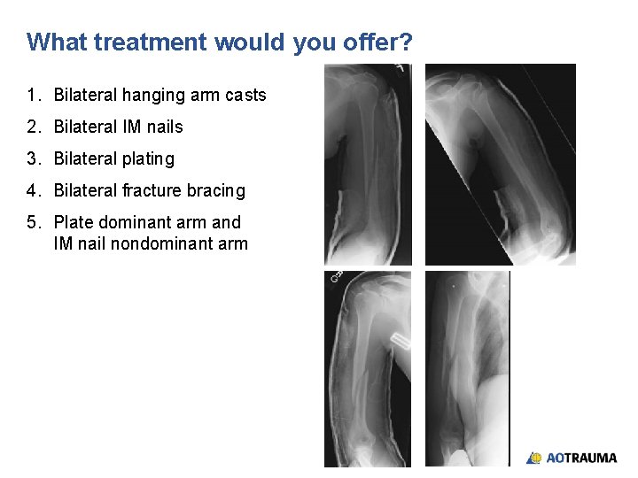 What treatment would you offer? 1. Bilateral hanging arm casts 2. Bilateral IM nails
