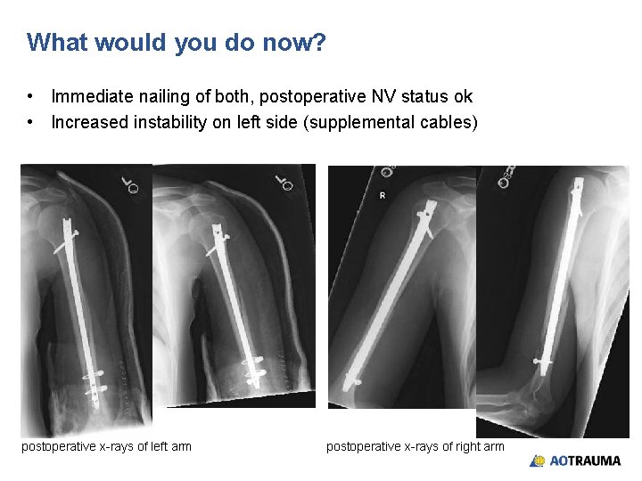 What would you do now? • Immediate nailing of both, postoperative NV status ok