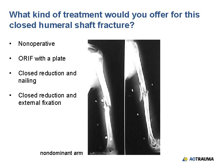 What kind of treatment would you offer for this closed humeral shaft fracture? •