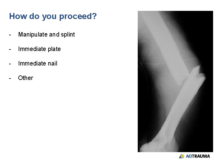 How do you proceed? - Manipulate and splint - Immediate plate - Immediate nail