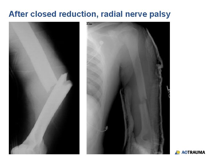 After closed reduction, radial nerve palsy 