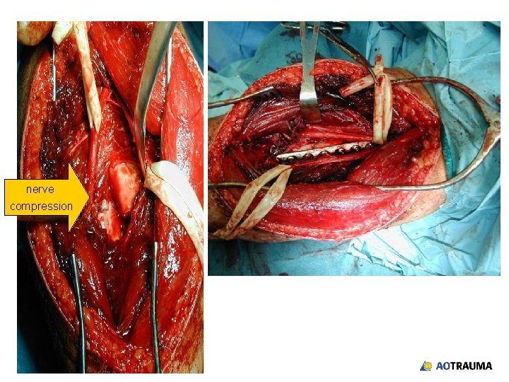 nerve compression 