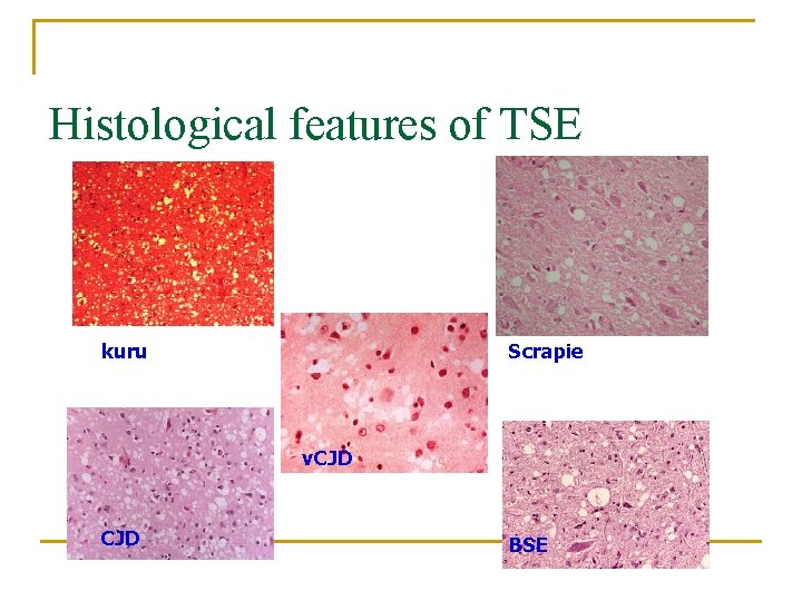 Histological features of TSE kuru Scrapie v. CJD BSE 