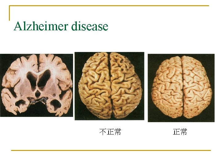 Alzheimer disease 不正常 正常 