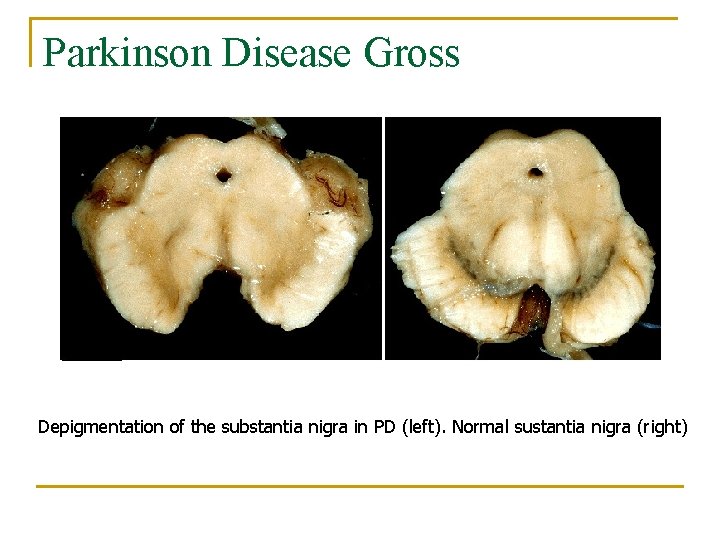 Parkinson Disease Gross Depigmentation of the substantia nigra in PD (left). Normal sustantia nigra