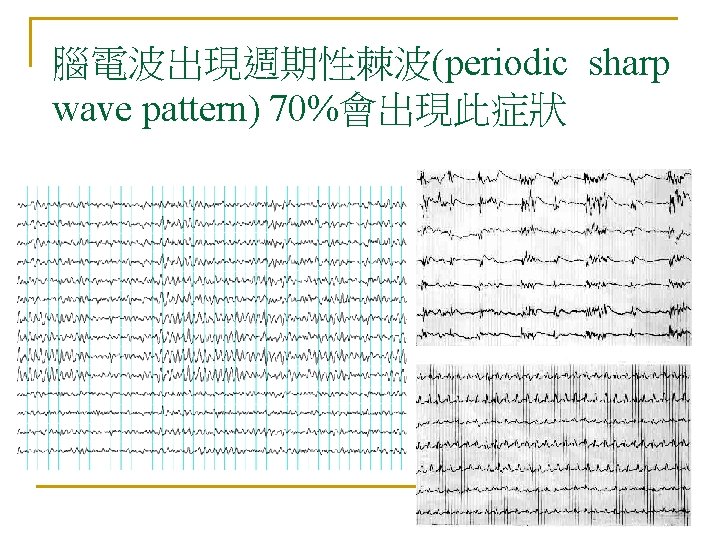 腦電波出現週期性棘波(periodic sharp wave pattern) 70%會出現此症狀 