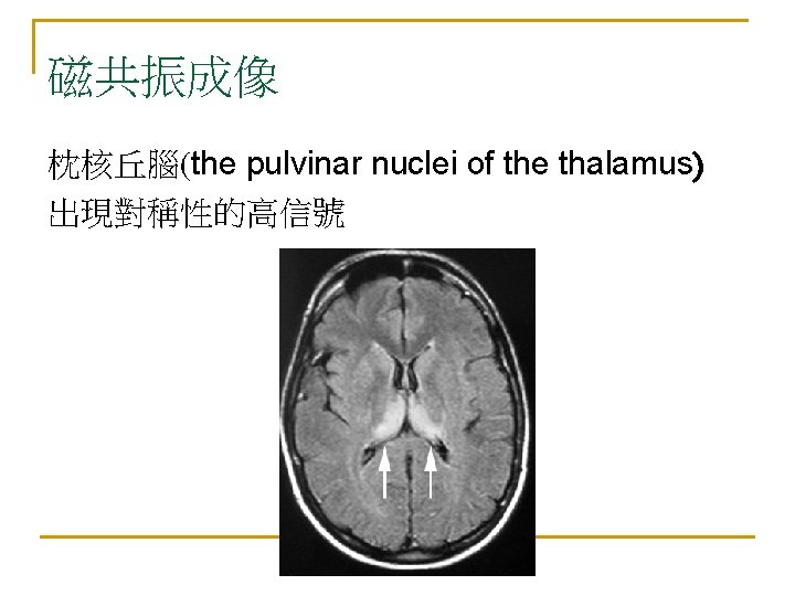 磁共振成像 枕核丘腦(the pulvinar nuclei of the thalamus) 出現對稱性的高信號 