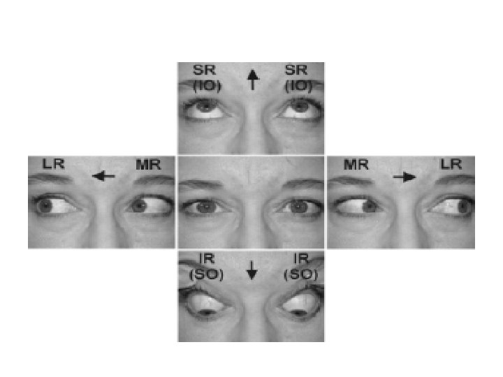 Diplopia Dr Mohammed Alanazy Versions Terminology Esotropia Exotropia