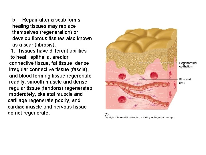 b. Repair-after a scab forms healing tissues may replace themselves (regeneration) or develop fibrous