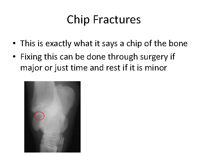 Chip Fractures • This is exactly what it says a chip of the bone Chip Fractures • This is exactly what it says a chip of the bone