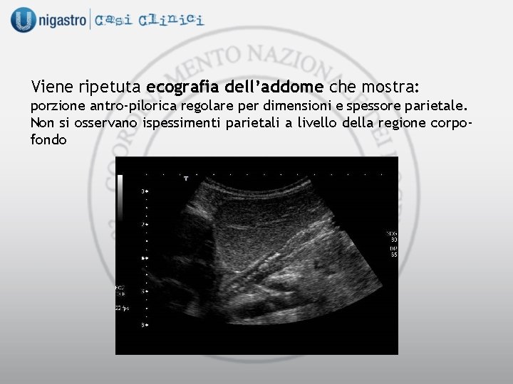 Viene ripetuta ecografia dell’addome che mostra: porzione antro-pilorica regolare per dimensioni e spessore parietale.