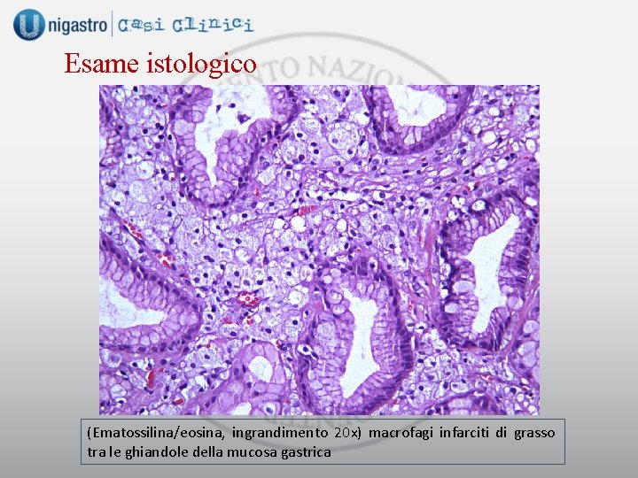 Esame istologico (Ematossilina/eosina, ingrandimento 20 x) macrofagi infarciti di grasso tra le ghiandole della