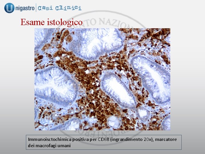 Esame istologico Immunoisctochimica positiva per CD 68 (ingrandimento 20 x), marcatore dei macrofagi umani