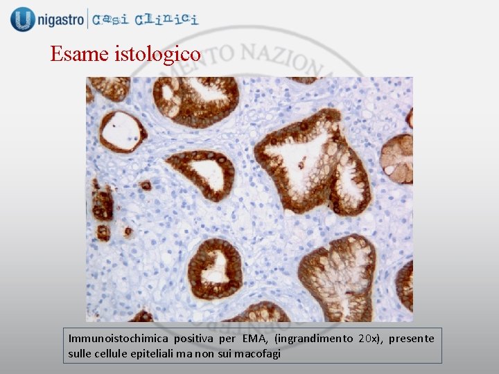 Esame istologico Immunoistochimica positiva per EMA, (ingrandimento 20 x), presente sulle cellule epiteliali ma