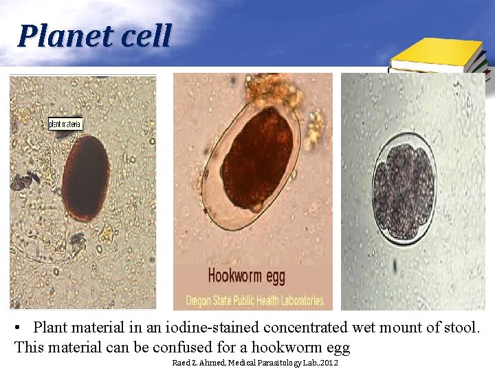 Planet cell • Plant material in an iodine-stained concentrated wet mount of stool. This