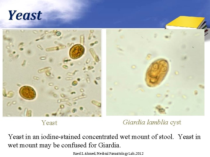 Yeast Giardia lamblia cyst Yeast in an iodine-stained concentrated wet mount of stool. Yeast