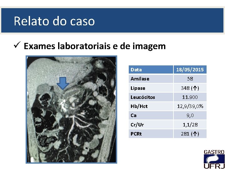 Relato do caso ü Exames laboratoriais e de imagem Data Amilase 18/05/2015 58 Lipase