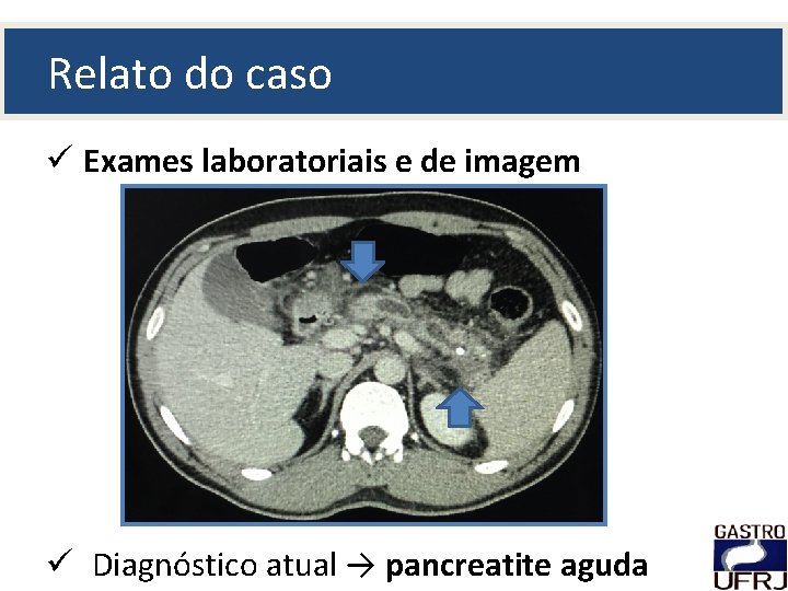 Relato do caso ü Exames laboratoriais e de imagem ü Diagnóstico atual → pancreatite