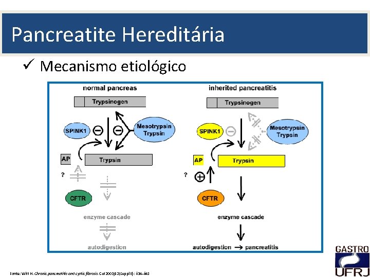 Pancreatite Hereditária ü Mecanismo etiológico Fonte: Witt H. Chronic pancreatitis and cystic fibrosis. Gut