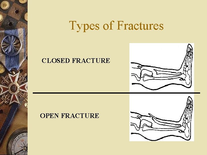 Types of Fractures CLOSED FRACTURE OPEN FRACTURE 