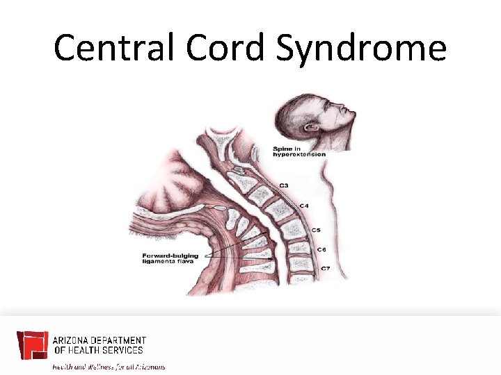 Central Cord Syndrome 