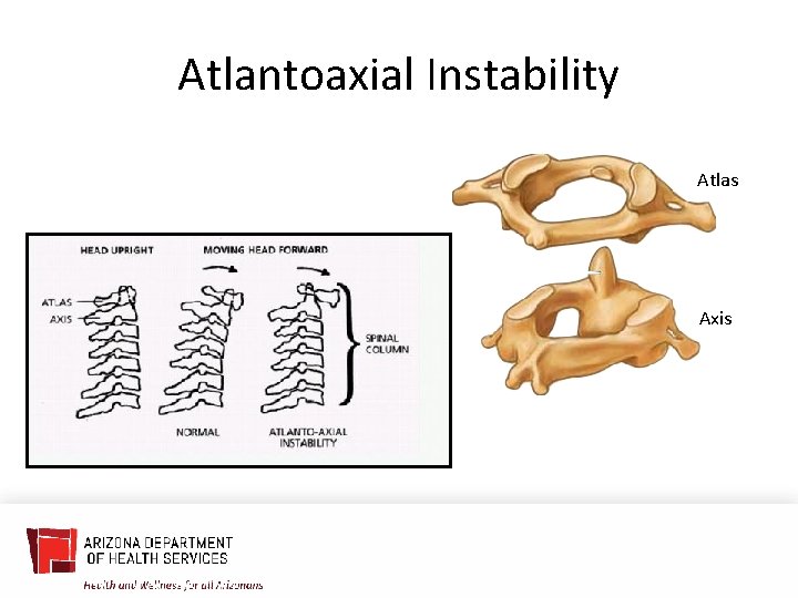 Atlantoaxial Instability Atlas Axis 