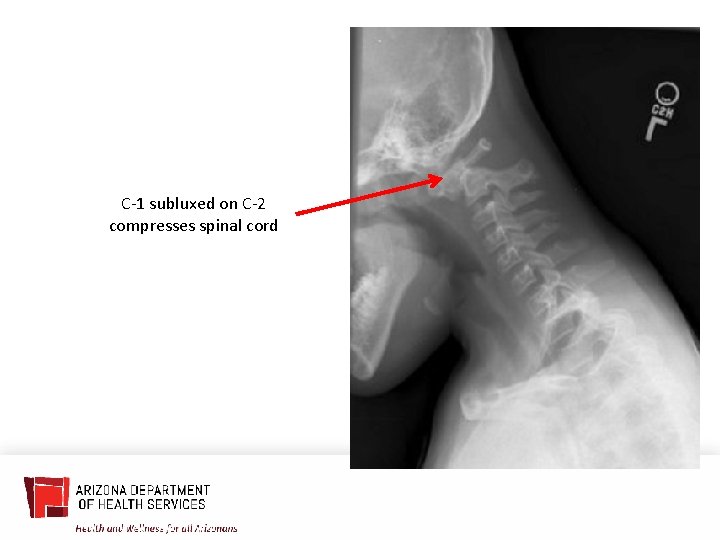 C-1 subluxed on C-2 compresses spinal cord 