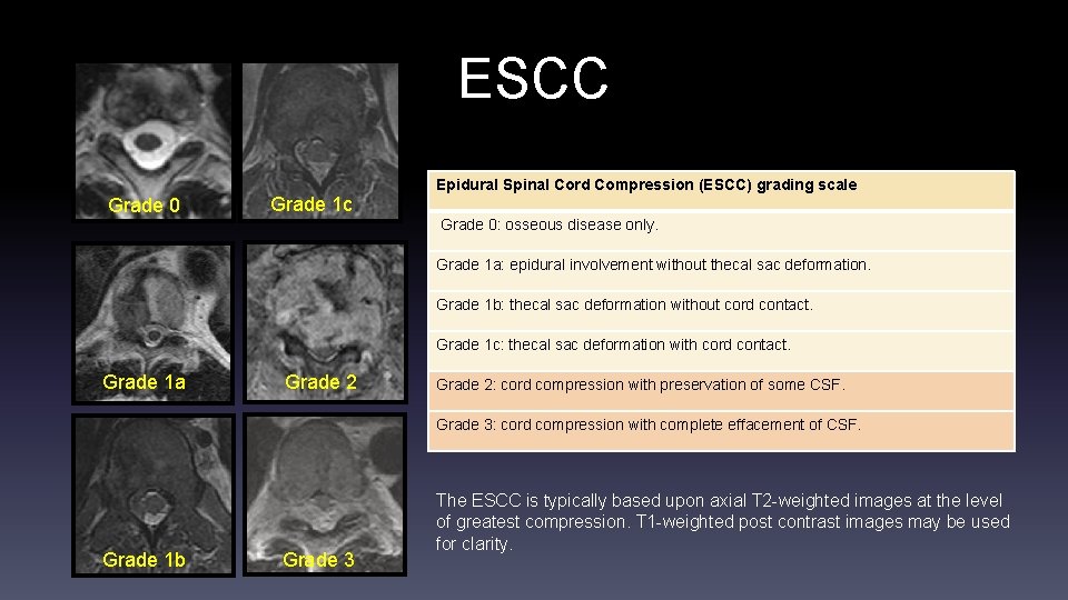 ESCC Grade 0 Grade 1 c Epidural Spinal Cord Compression (ESCC) grading scale Grade