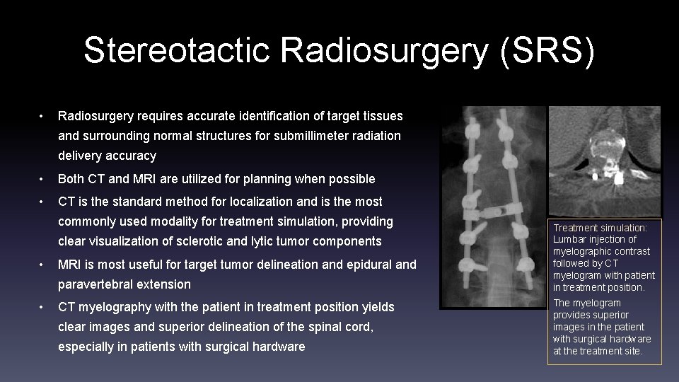 Stereotactic Radiosurgery (SRS) • Radiosurgery requires accurate identification of target tissues and surrounding normal