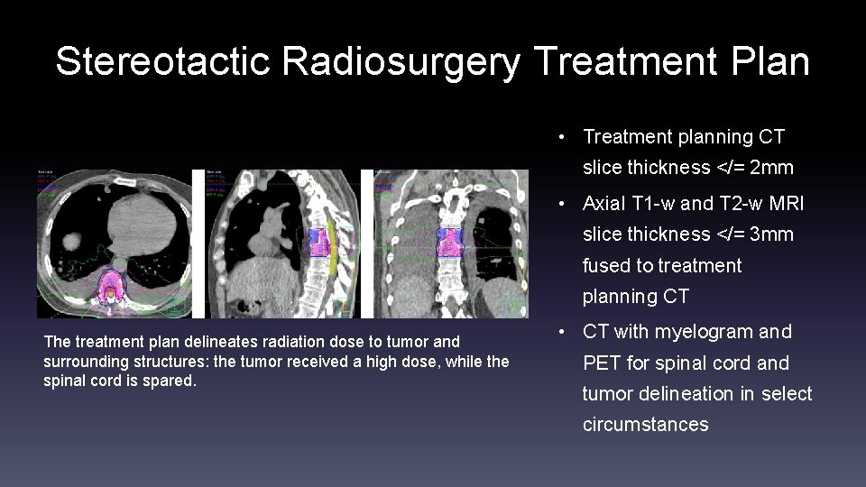 Stereotactic Radiosurgery Treatment Plan • Treatment planning CT slice thickness </= 2 mm •